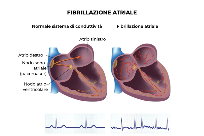 sistema di conduttività del cuore normale a confronto con un caso di aritmia cardiaca