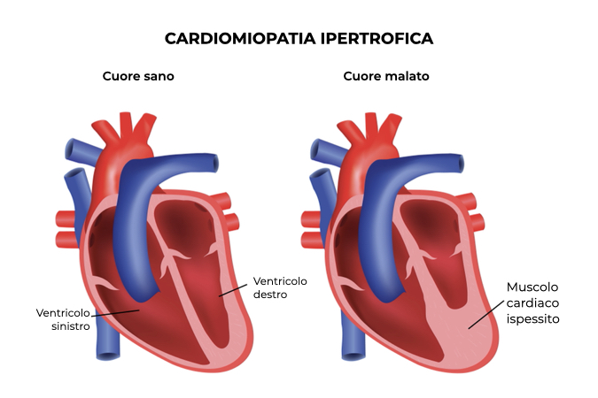 Illustrazione di un cuore sano e uno con muscolo cardiaco ispessito per cardiomiopatia ipertrofica