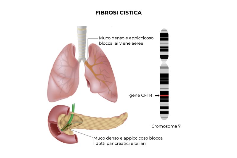 Illustrazione di un polmone e dotti biliari e pancreatici con fibrosi cistica