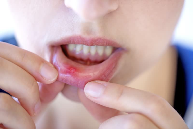Foto di labbro inferiore della bocca affetto da stomatite