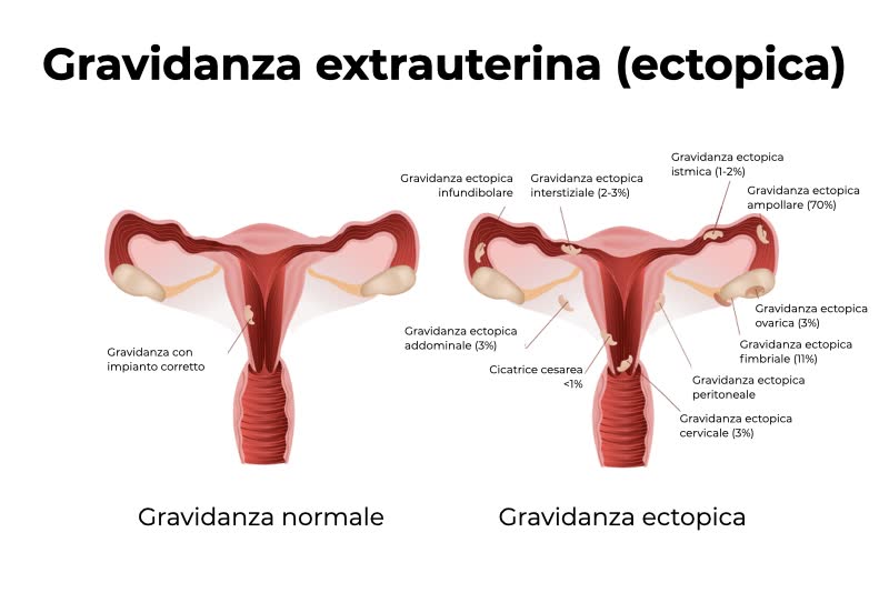 Illustrazione 3D con due uteri durante una gravidanza: a sinistra mentre si svolge una gravidanza normale, a destra con le varie possibili forme di gravidanza ectopica
