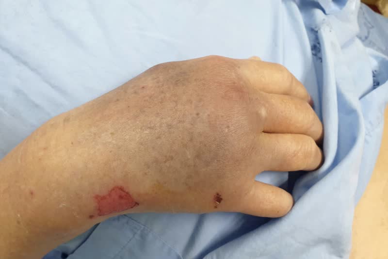 Foto della mano destra di una persona che soffre di vasculite
