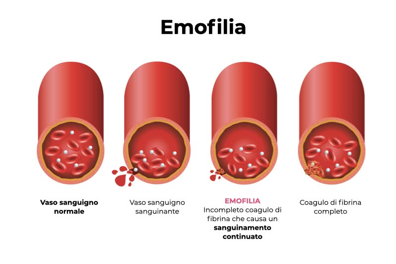 Illustrazione di vasi sanguigni normali, sanguinanti e afflitti da emofilia