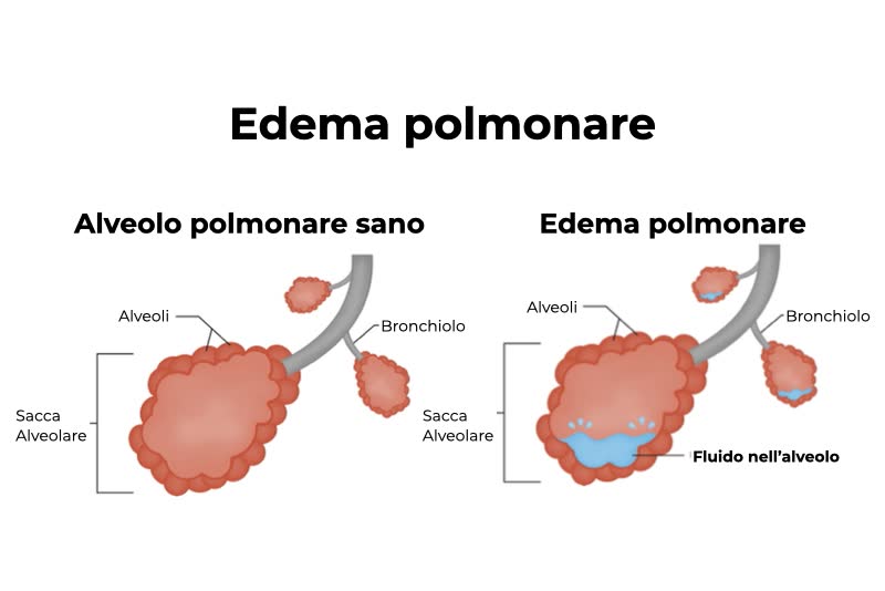 Illustrazione di alveolo polmonare sano e alveolo affetto da edema polmonare