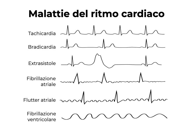 Illustrazione delle malattie del ritmo cardiaco, tra cui la bradicardia
