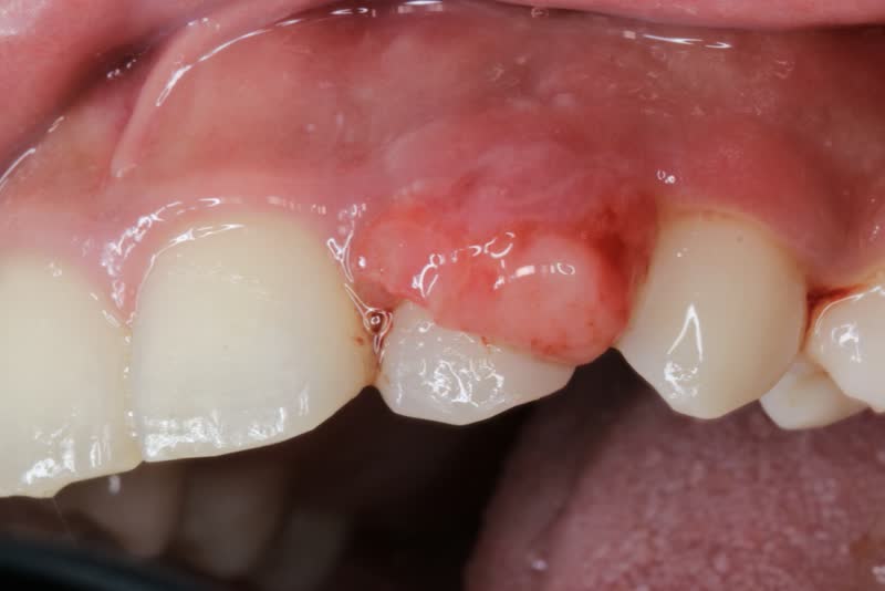 Foto di granuloma dentale