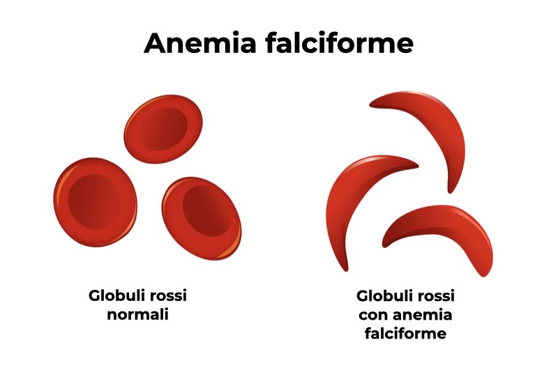 Illustrazione grafica dei globuli rossi con anemia falciforme