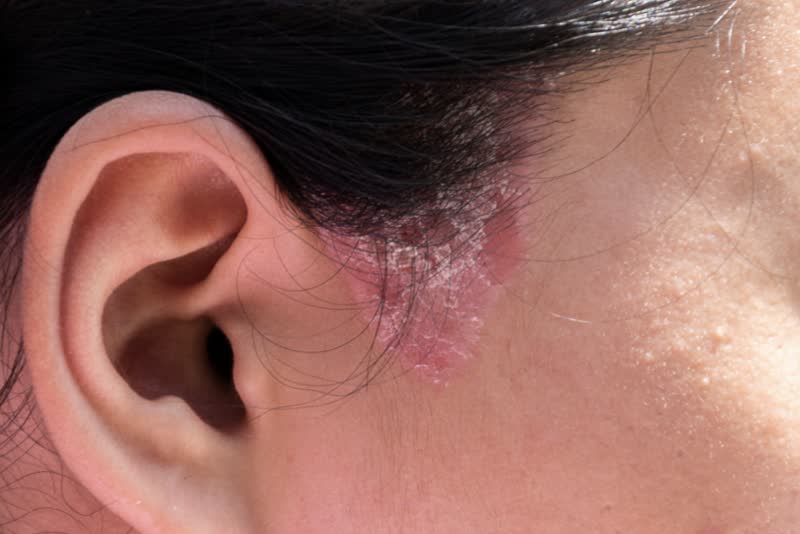 Foto di infezione funginea (micosi) all'orecchio di una donna bruna