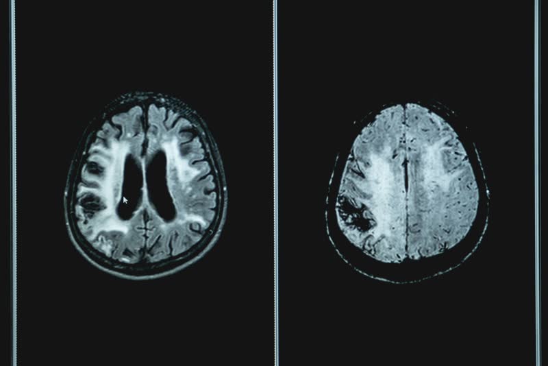 Immagine di risonanza magnetica di cervello con demenza vascolare