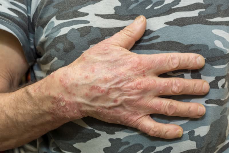 Foto di soggetto con mani coperte da eczema disidrosico (disidrosi)