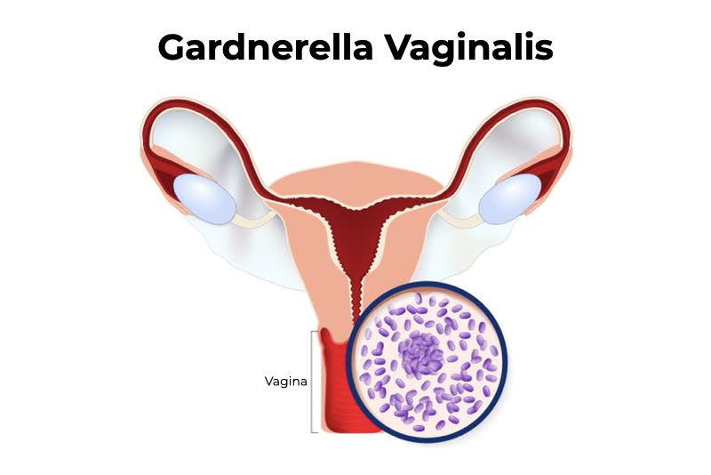 Illustrazione di organo genitale femminile che descrive la zona che viene colpita dal virus della gardnerella vaginalis