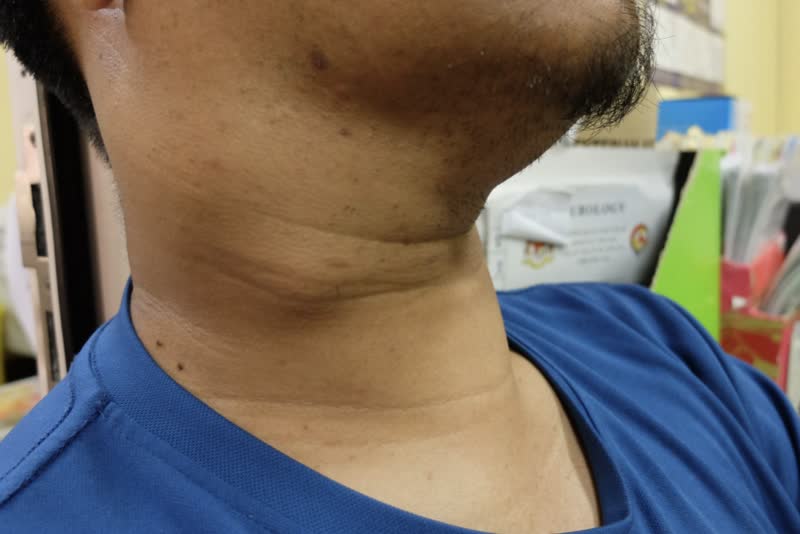 Foto di uomo con linfonodi del collo ingrossati a causa della linfoadenopatia