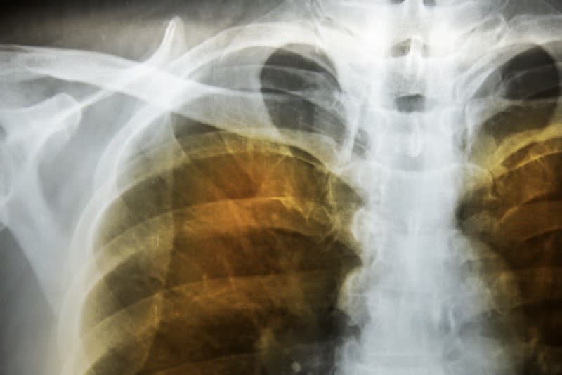 Foto di radiografia a polmoni con enfisema