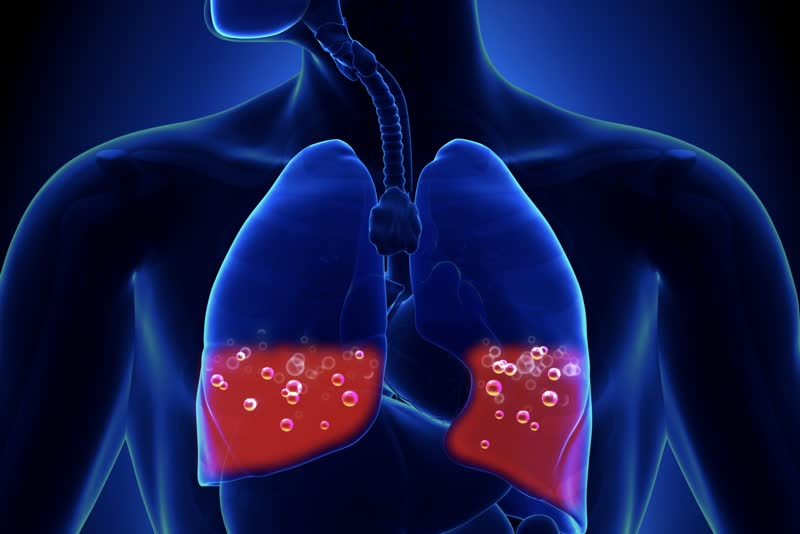 Illustrazione di un torace di polmoni con liquido a causa dell'edema polmonare