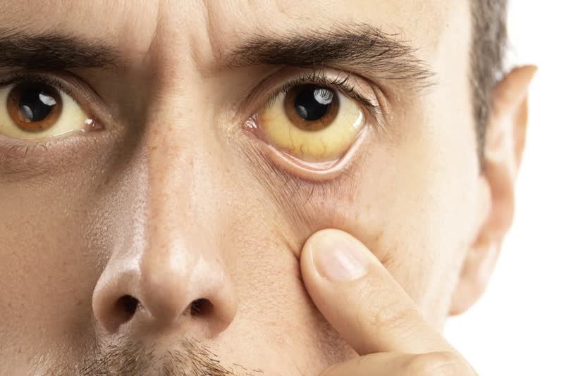 Uomo con ittero, un sintomo dell'epatite autoimmune, caratterizzato da occhi con colore giallo per malfunzionamento epatico