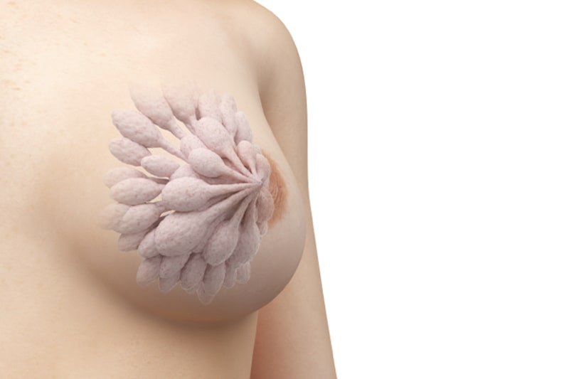 Illustrazione 3d del seno di una donna per descrivere la quadrantectomia
