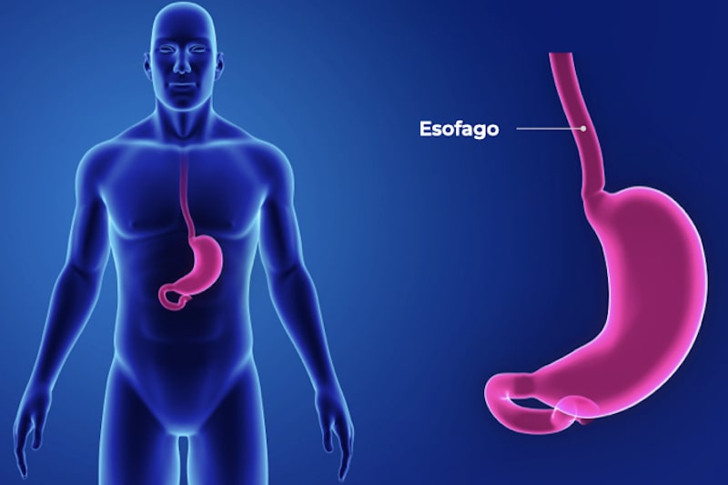 Esofago di Barrett (Metaplasia di Barrett)