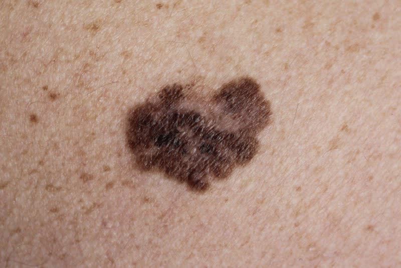 Melanoma